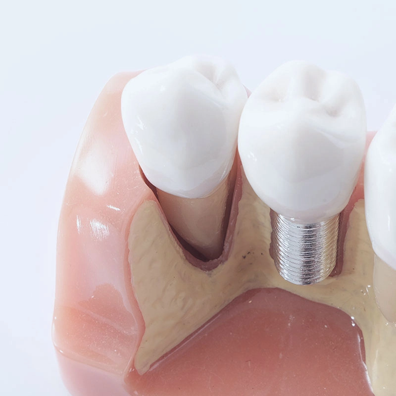 人工植牙